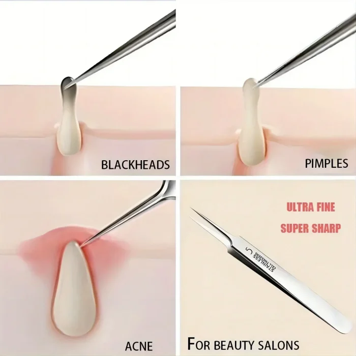 1 Pack Extra Fine No. 5 Cellular Acne Blackhead Tweezers - Facial Beauty Remove Acne Needle Tools for Skin Care - Image 5
