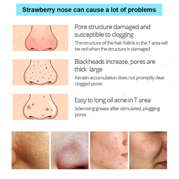 Unisex Deep Cleansing Nose Strips for Acne & Blackhead Removal Shrink Pore Nose Black Head Stickers Skin Care Patch - Image 15